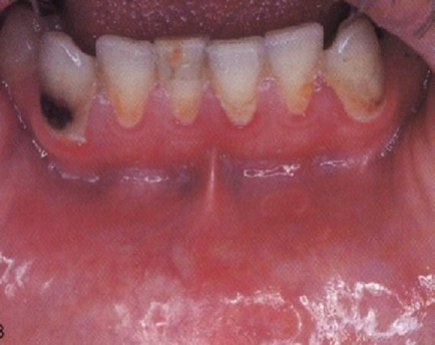 <p>geographic tongue used to describe areas found on mucosal surfaces other than the tongue</p>