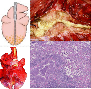 <p>What pattern of lung pathology? Describe appearance. Give 3 example causes. </p>