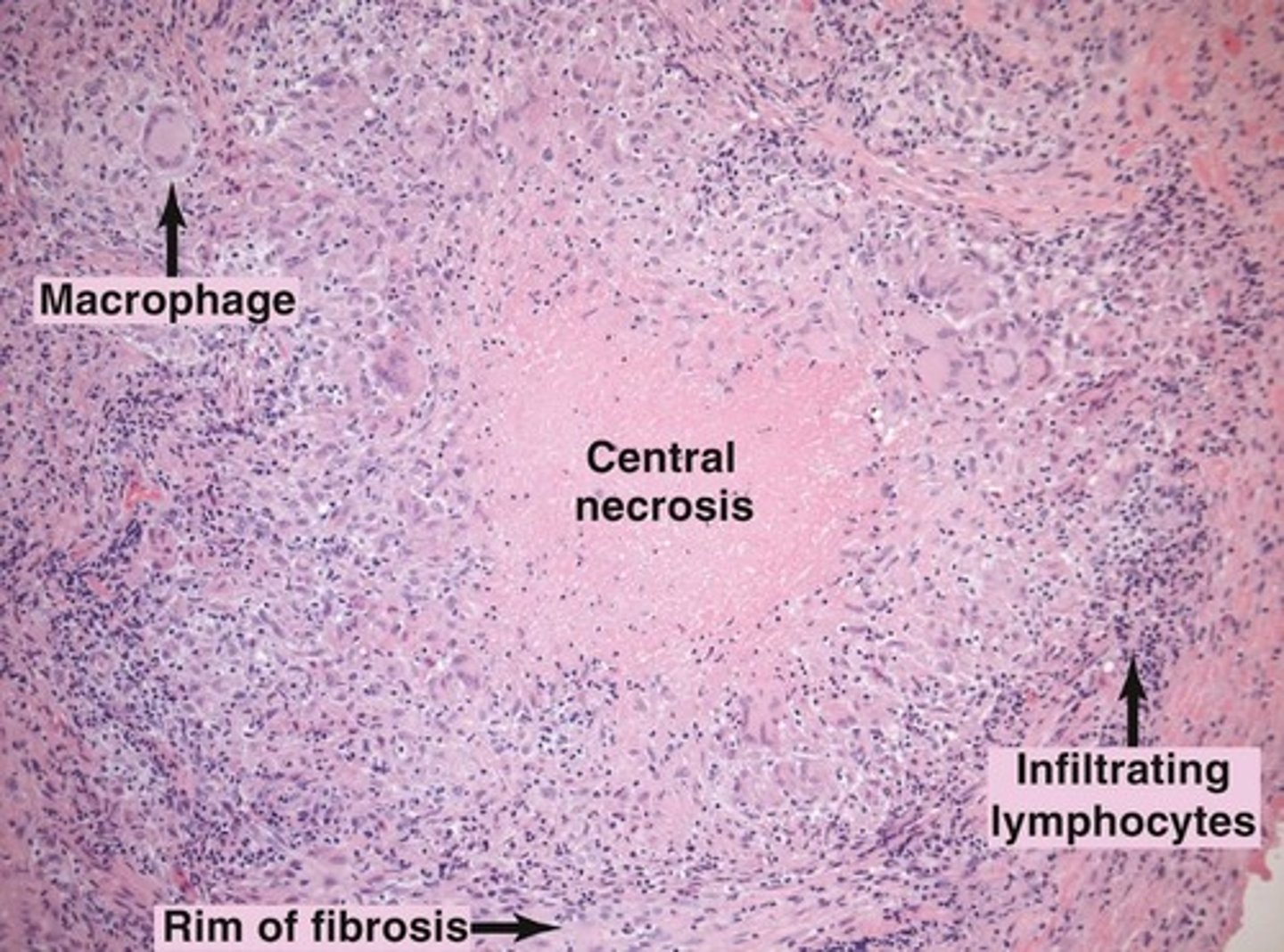 <p>A structure that walls off an intracellular pathogen, formed around infected macrophages.</p>