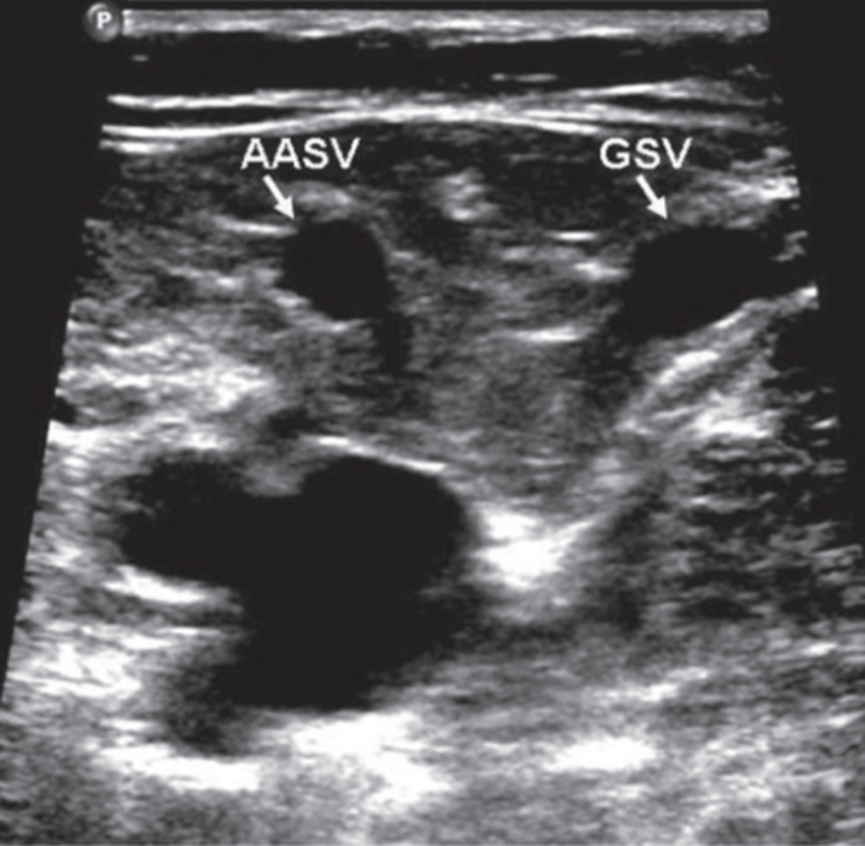 <p>Runs parallel and anterior to femoral vein</p>