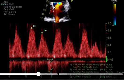 <p>what single is this measurement for what are you going to peak, why would this doppler be important</p>