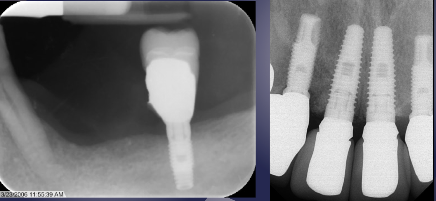 <p>which restorative material?</p>
