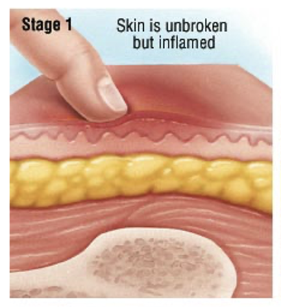<ul><li><p>Unbroken, non-blanching skin</p></li><li><p>Erythema and pain</p></li></ul>