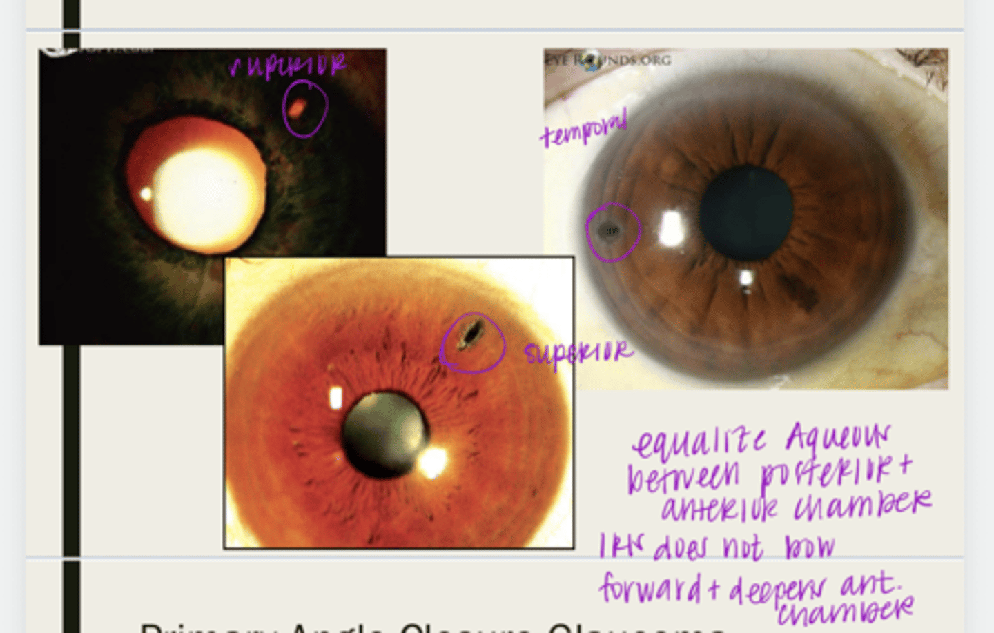 <p>What is the treatment that we should present to a patient that is a primary angle closure suspect?</p>