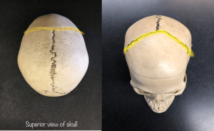 <p>Separates parietal and frontal bone</p>