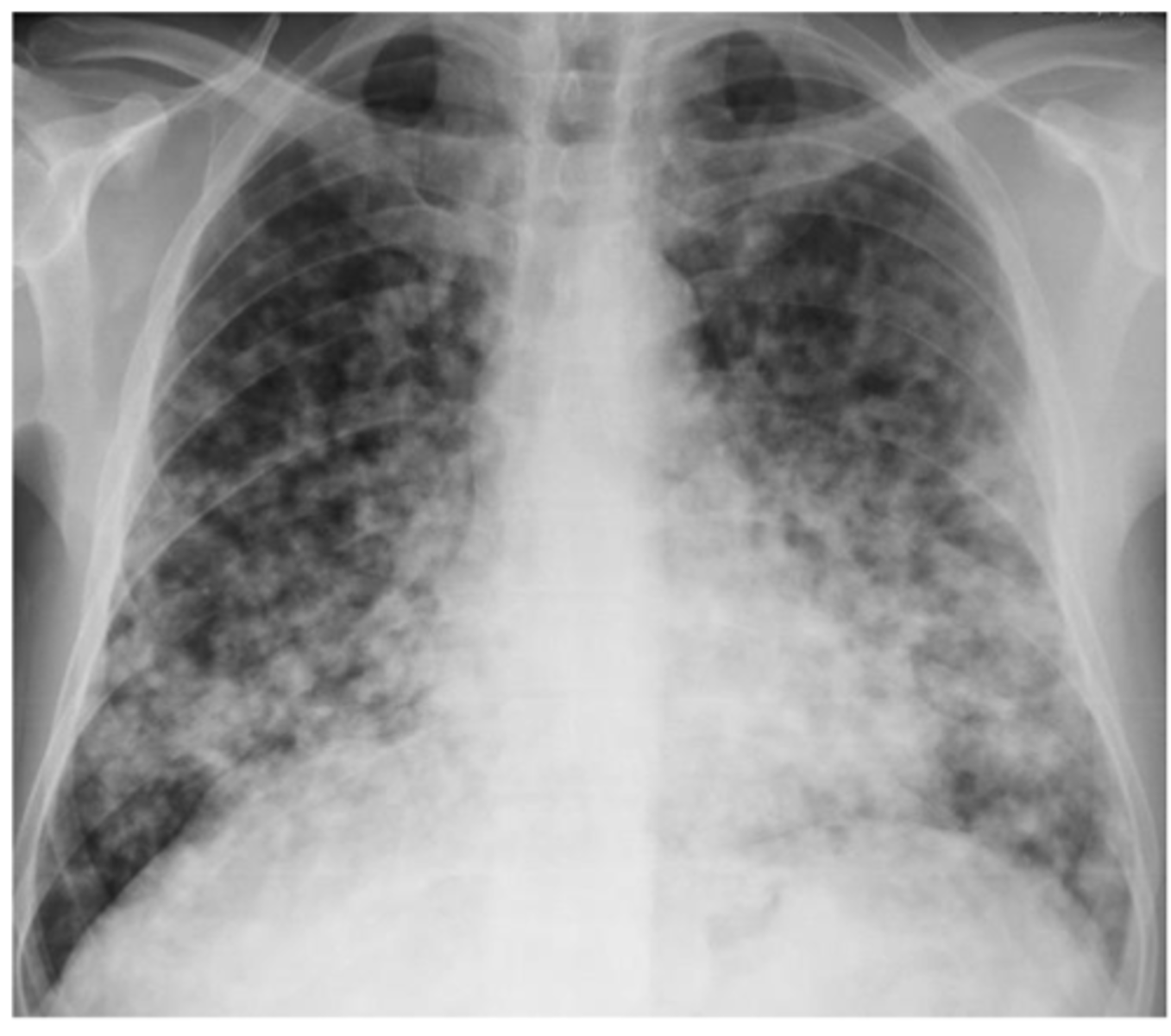 <p>alveolar infiltrate - looks "fluffy</p>