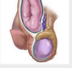 <p><strong>Scrotal Hernia</strong></p><p>-Inguinal ______</p><p>-Inspection → scrotal __________. Swelling may worsen or may have pain with straining, may reduce when ______, and does ___ transilluminate </p><p>-Palpation → soft, fluctuant mass. Palpating fingers cannot get above mass, meaning ____ is distinct from testicle that is normal. </p>