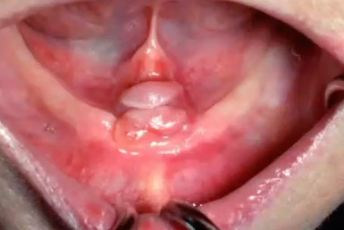 <p>what is the cause of this lesion </p>
