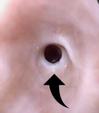 <p>Esophageal Stricture</p>