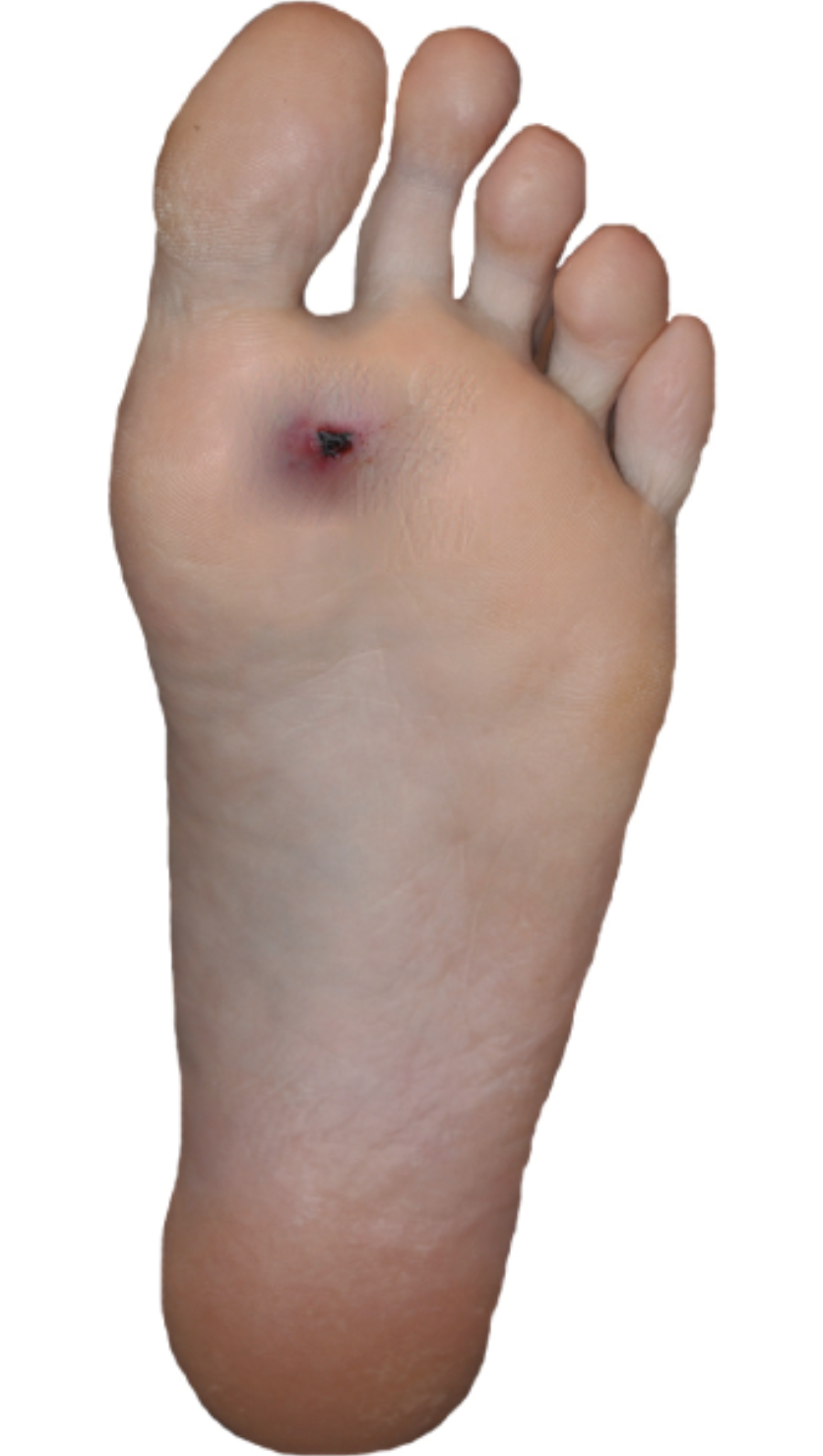 what type of skin wound?