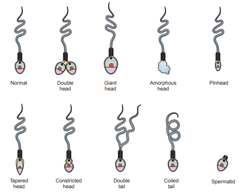 Figure 5: Abnormalities of spermatozoa heads and tails