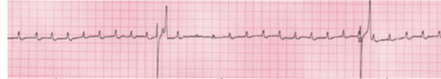 <p>what type of arrhythmia do we see here?</p>