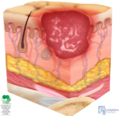 <ul><li><p>partial thickness loss of skin w/ exposed dermis</p></li><li><p>adipose not visible</p></li></ul><p></p>