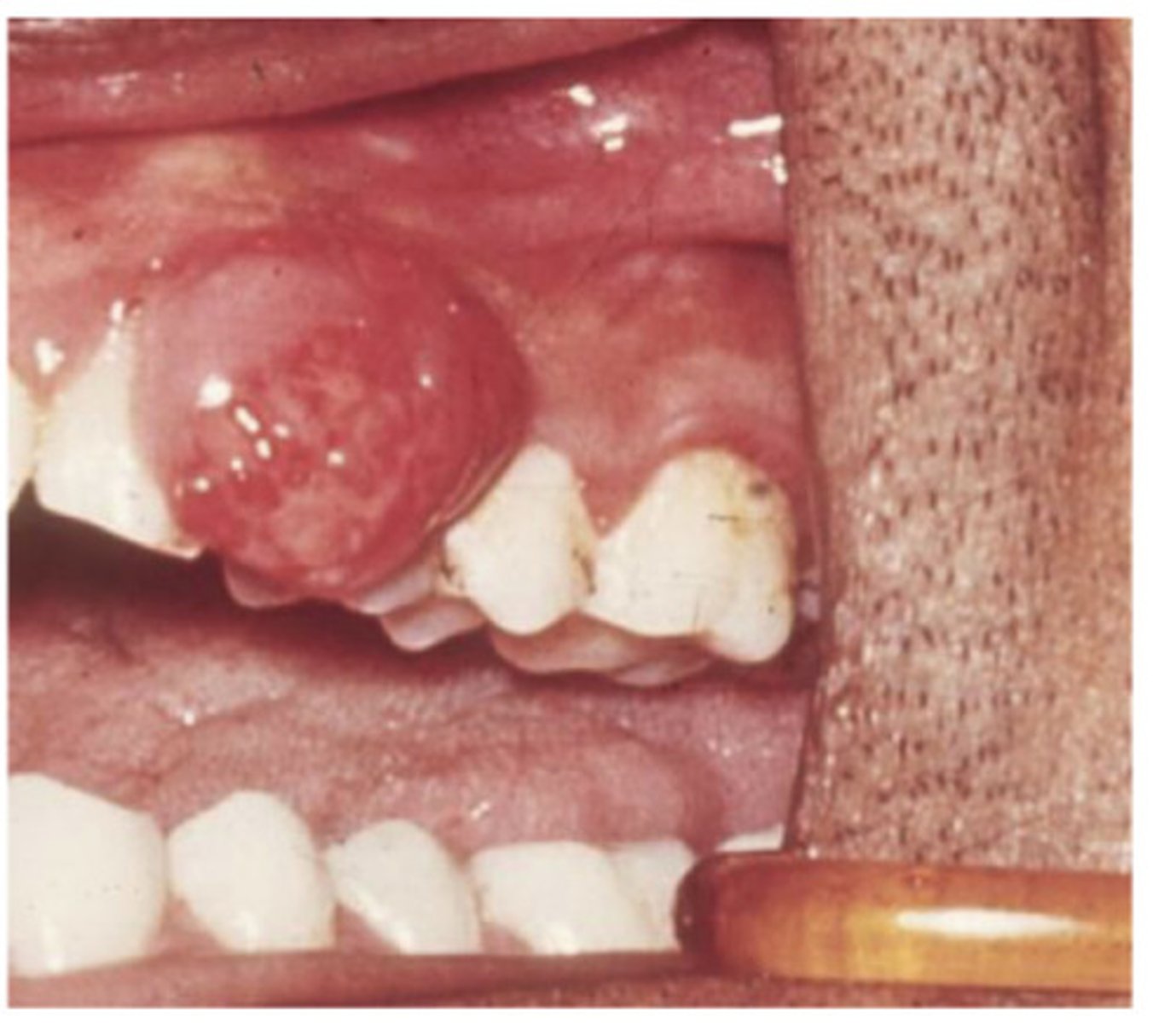 <p>Unknown aetiology, red, haemorrhagic and soft, occasional superficial bone erosion - usually excised - what am i?</p>