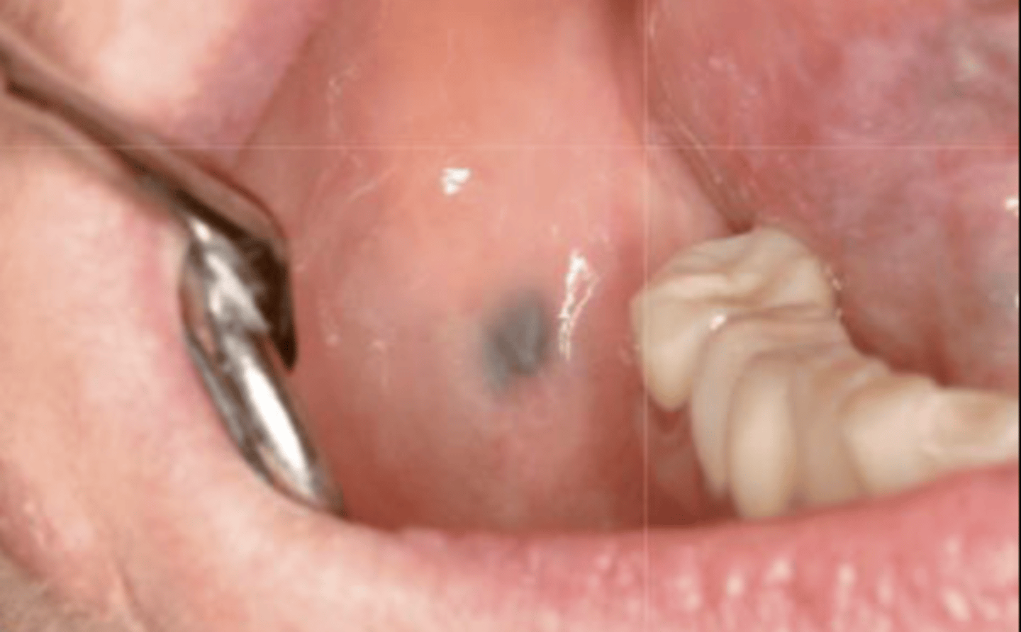 <p>What type of pigmented lesion?</p>