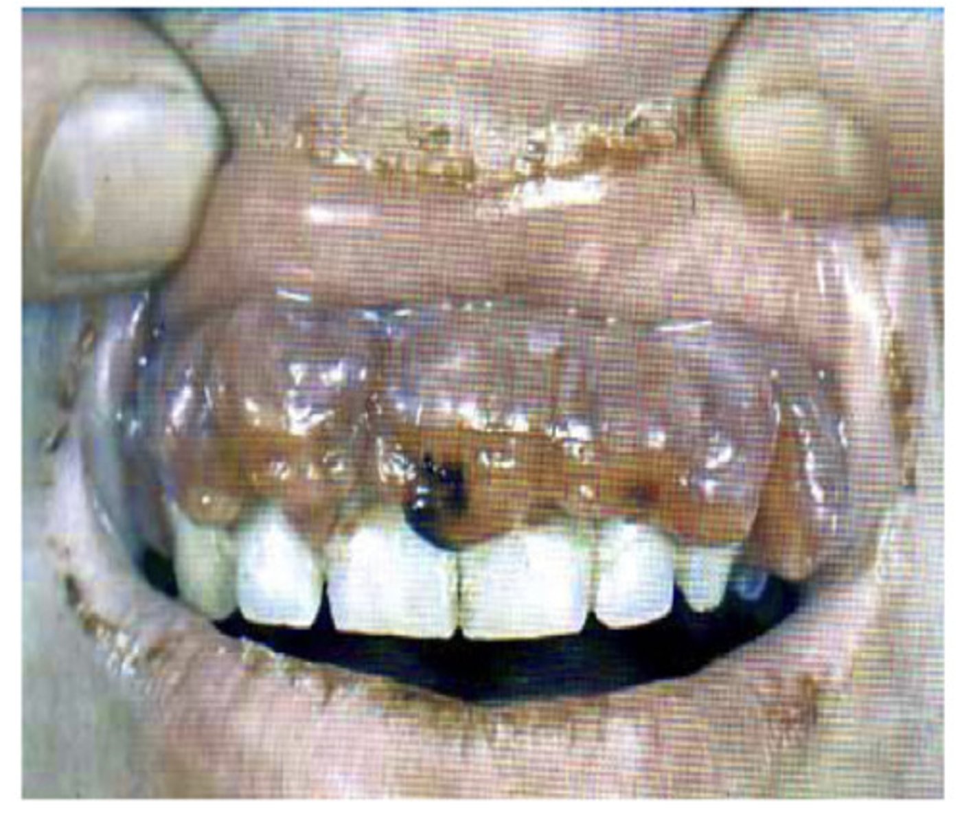 <p>Caused by vitamin C deficiency - causes gingival overgrowth and bleeding - what am i?</p>