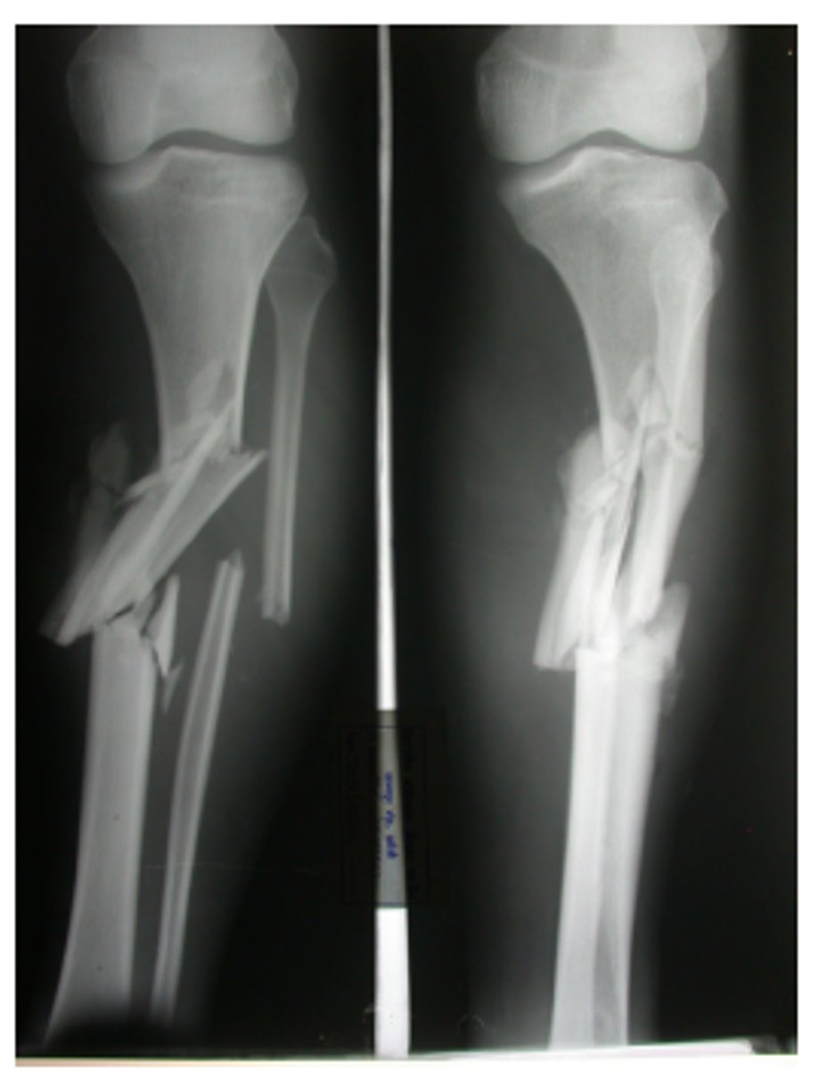 <p>Fracture in which the bone breaks into small pieces</p>