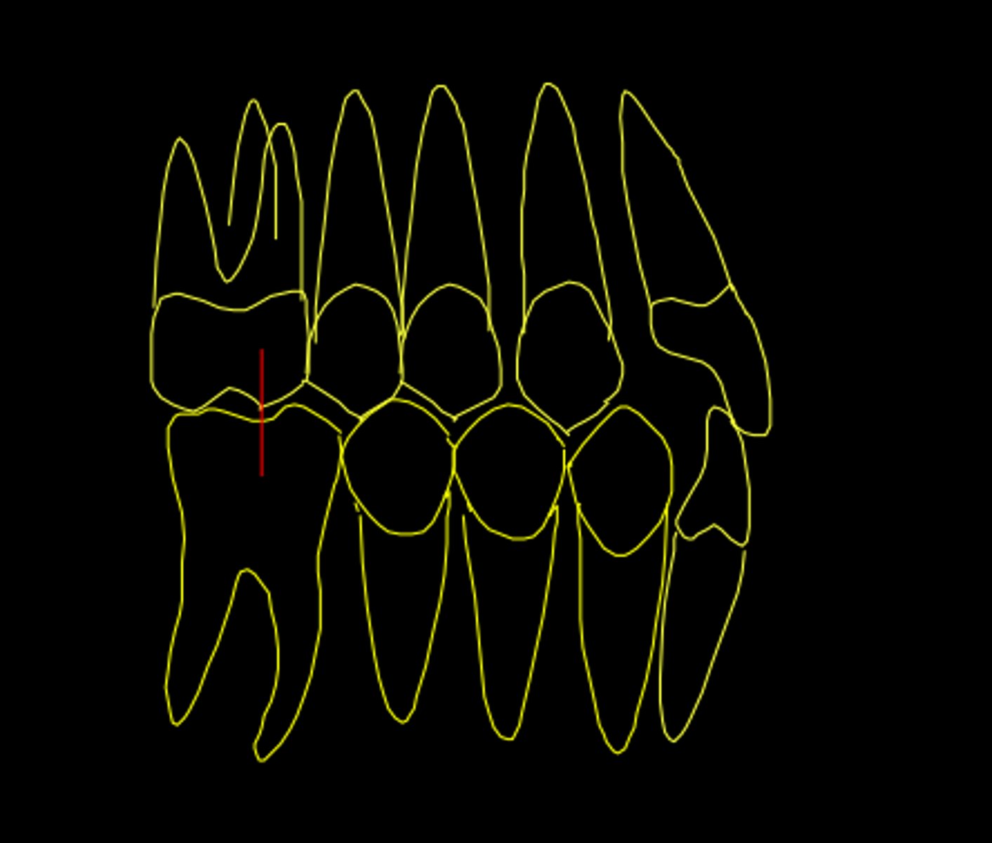 <p>ID the class of occlusion:</p>