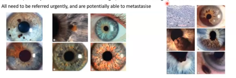 <p>iris tumours </p>