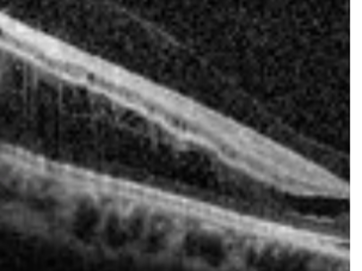 <p>a splitting of the sensory retina (NOT A RETINAL DETACHMENT). Is usually bilateral (useful for differentiating from RD) occurring in the inferior temporal quadrant. Is usually asymptomatic, but causes an absolute VF defect. Holes of the inner and outer retina may occur, posing a small risk for retinal detachment.</p>