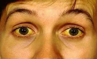 <p>an even yellowing of the sclera extending up to the cornea</p><ul><li><p>indicates jaundice</p></li></ul>