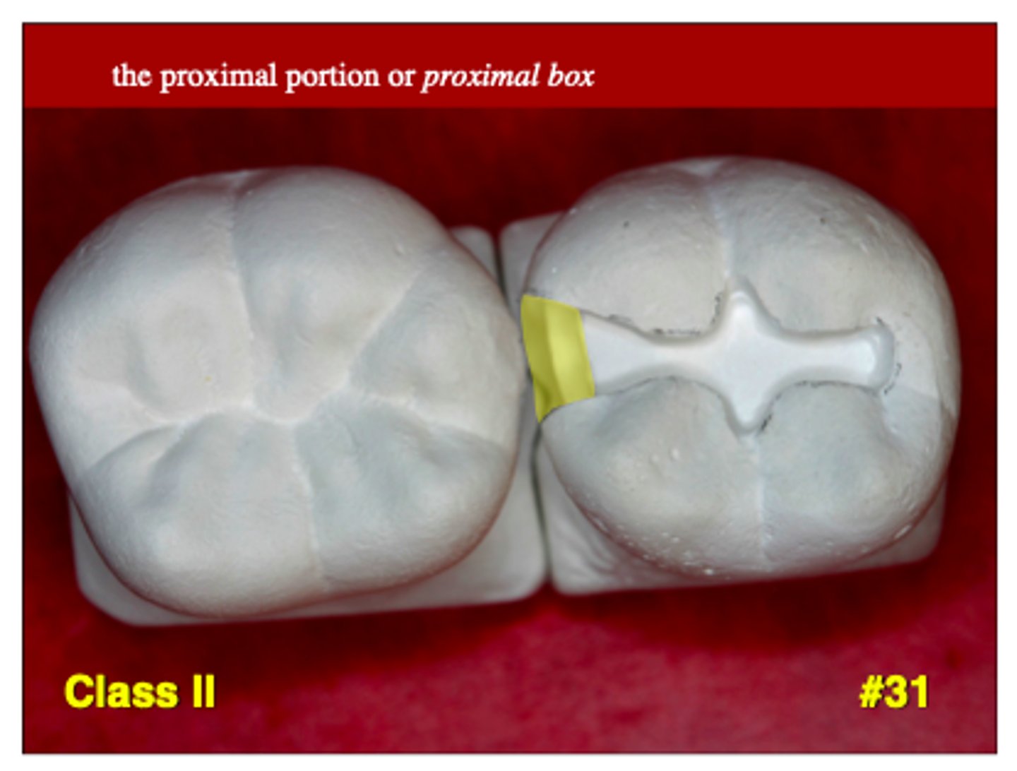 <p>the axial depth on the M or D side of a class II restoration</p>