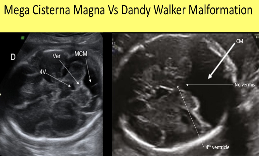 <p>which describe how to differentiate <strong>mega cisterna magna </strong>from<strong> dandy walker</strong> malformation</p><p>a) neurosonology exam done post-partum</p><p>b) a normal cerebellar vermis is usually seen w/DWM but not w/mega cisterna magna</p><p>c) a normal cerebellar vermis is usually seen w/mega cisterna magna but not w/DWM</p><p>d) fetal MRI</p>
