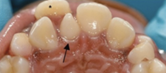 <p>Afwijking in het aantal: Het gebeurt ook wel eens dat er boventallige elementen zijn. Er zijn meer elementen of er is geen ruimte meer. Het is een kleiner aangelegd element. Een voorbeeld hiervan is een <span><strong><span>mesiodens</span></strong></span>, een element extra. Vaak wordt zo’n elementverwijderd en gaat de orthodontist aan de slag om de elementen mooi in een tandboog te krijgen. Deze mesiodens is niet nodig en noemen we dus boventallig.</p>