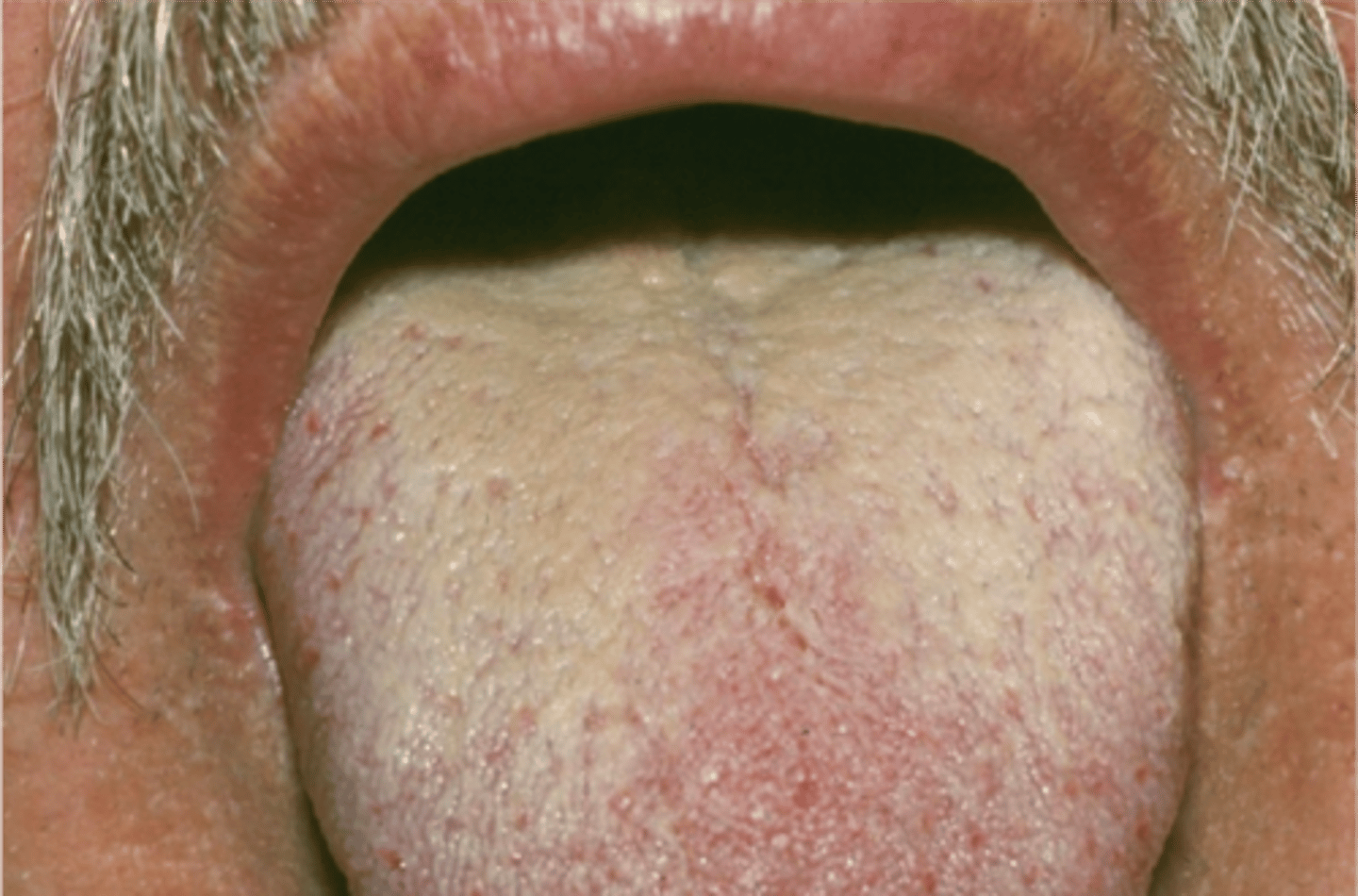 <p>Numerous bacteria and</p><p>desquamated epithelial cells</p><p>accumulate on the dorsal</p><p>tongue surface, but without the</p><p>hair-like filiform projections</p>