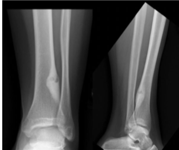 <p>17 y/o male presents to the clinic for progressively worsening leg pain. He says that he’s take ibuprofen for the pain. On physical exam you note erythematous, swollen, tender tibia. Xrays reveal intensely reactive bone around a radiolucent nidus (less than 1.5 cm). CT reveals a nidus with scleoritic rim. What is your <strong><u>operative treatment </u></strong>plan?</p>