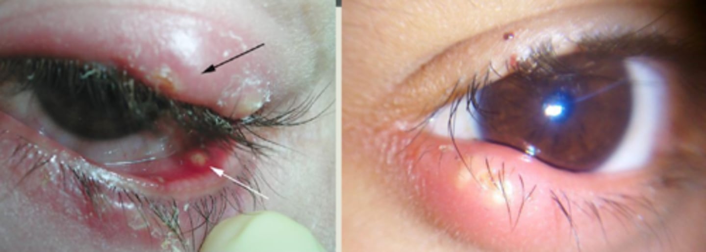 <p>bacterial infection (Staph) of the sebaceous glands of the eyelid:</p><p>Gland of Zeis = lash follicle, more exterior</p><p>Meibomian gland = more interior</p>