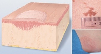 <p>papule with a surface elevation greater than 1cm in width</p><p>ex: psoriasis</p>