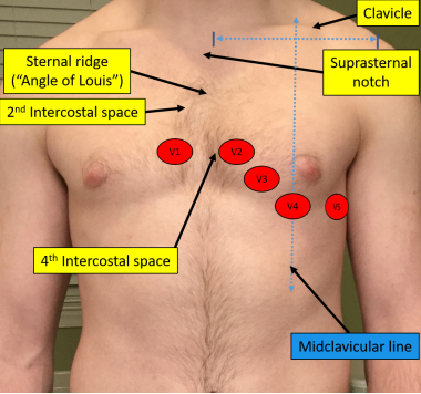 <p>type of leads that take “images” straight through the torso to monitor the electrical current</p><p>-placed in the same place for every patient</p>