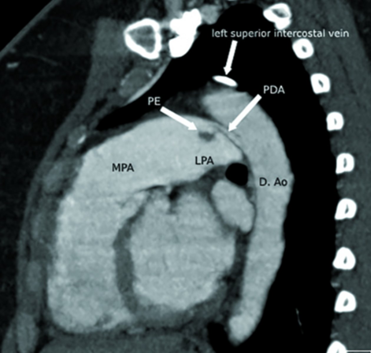 <p>Persistent connection between the pulmonary artery and aorta after birth.</p>