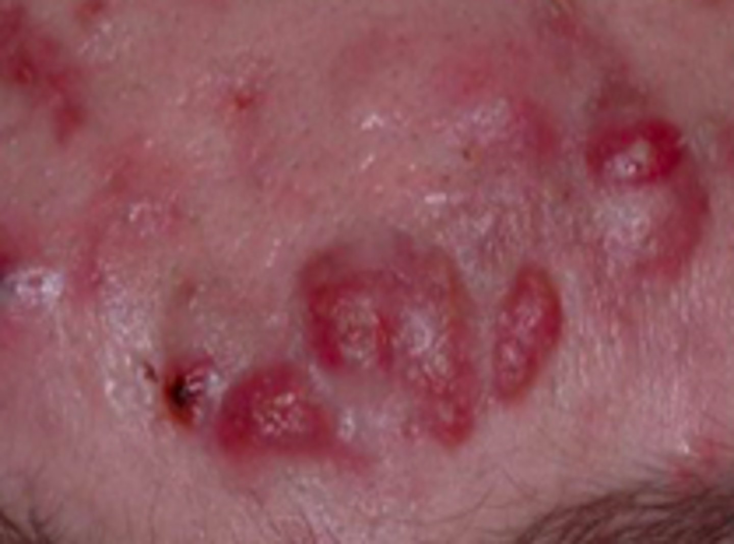 <p>Acneiform Disorders:</p><p>deep-seated, inflamed, often tender, large papules or nodules, “cystic acne”</p>