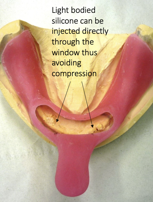 <p>window box tray technique for recording flabby/ fibrous ridges </p>