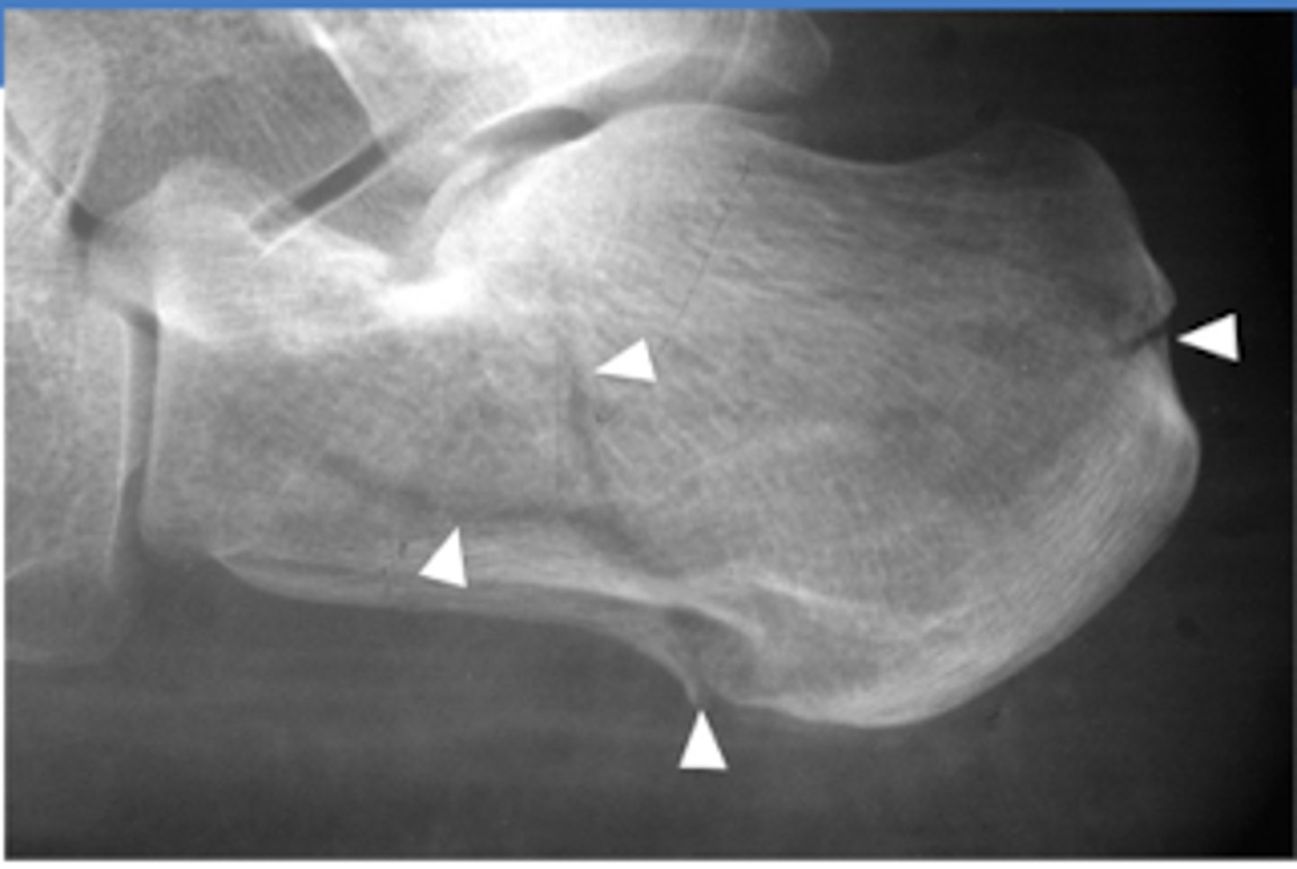 <p>calcaneus fracture</p>