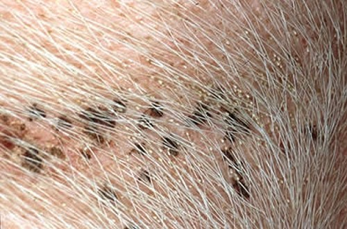 <p>Intense scratching, alopecia, skin thickening, pruritic skin damage</p>