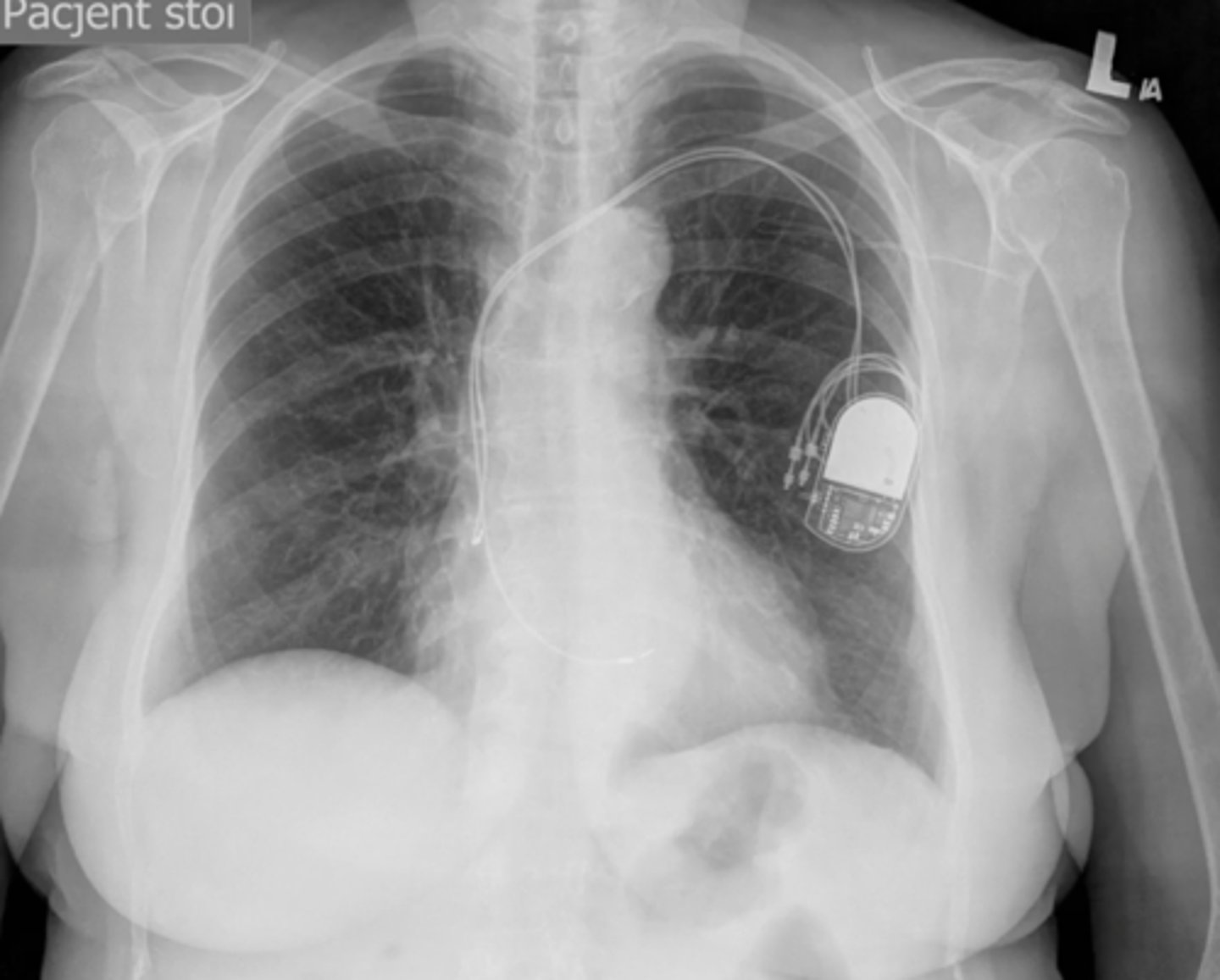 <p>device that connects to the right atrium and ventricle</p>