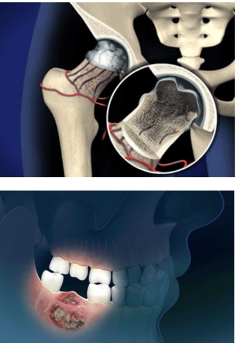 <p>Aseptic destruction of a segment of bone due to an interruption in blood flow</p><p>Sites with poor collateral circulation (e.g., femoral head) are most commonly affected</p><p>Symptoms:</p><p>- Depend on location &amp; severity</p><p>- Pain with activity (can progress to pain at rest)</p><p>Treatment:</p><p>- Short-term immobilization or limited weight-bearing</p><p>- Exercises</p><p>- NSAIDs</p><p>- Advanced: total joint replacement</p><p>Jaw osteonecrosis risk increases with bisphosphonate therapy</p>