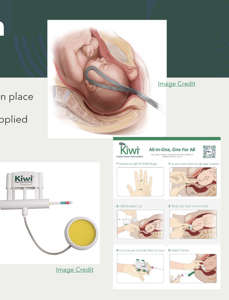 <ul><li><p>forceps</p><ul><li><p>2 curved blades that fit around baby’s ears and lock in place</p></li></ul></li><li><p>vacuum</p><ul><li><p>vacuum cup attaches to fetal head and pressure is applied</p></li></ul></li><li><p>MD provides traction<strong>&nbsp;with</strong> maternal pushing efforts</p></li></ul><p></p><p><strong>maternal complications</strong></p><ul><li><p>vaginal/cervical lacerations</p></li><li><p>hematoma</p></li></ul><p><strong>fetal complications</strong></p><ul><li><p>cephalohematoma</p><ul><li><p>can lead to jaundice and anemia&nbsp;</p></li></ul></li><li><p>face /scalp lacertaions or bruises&nbsp;</p><ul><li><p>can cause nerve damage</p></li></ul></li><li><p>facial palsy</p></li></ul><p></p>