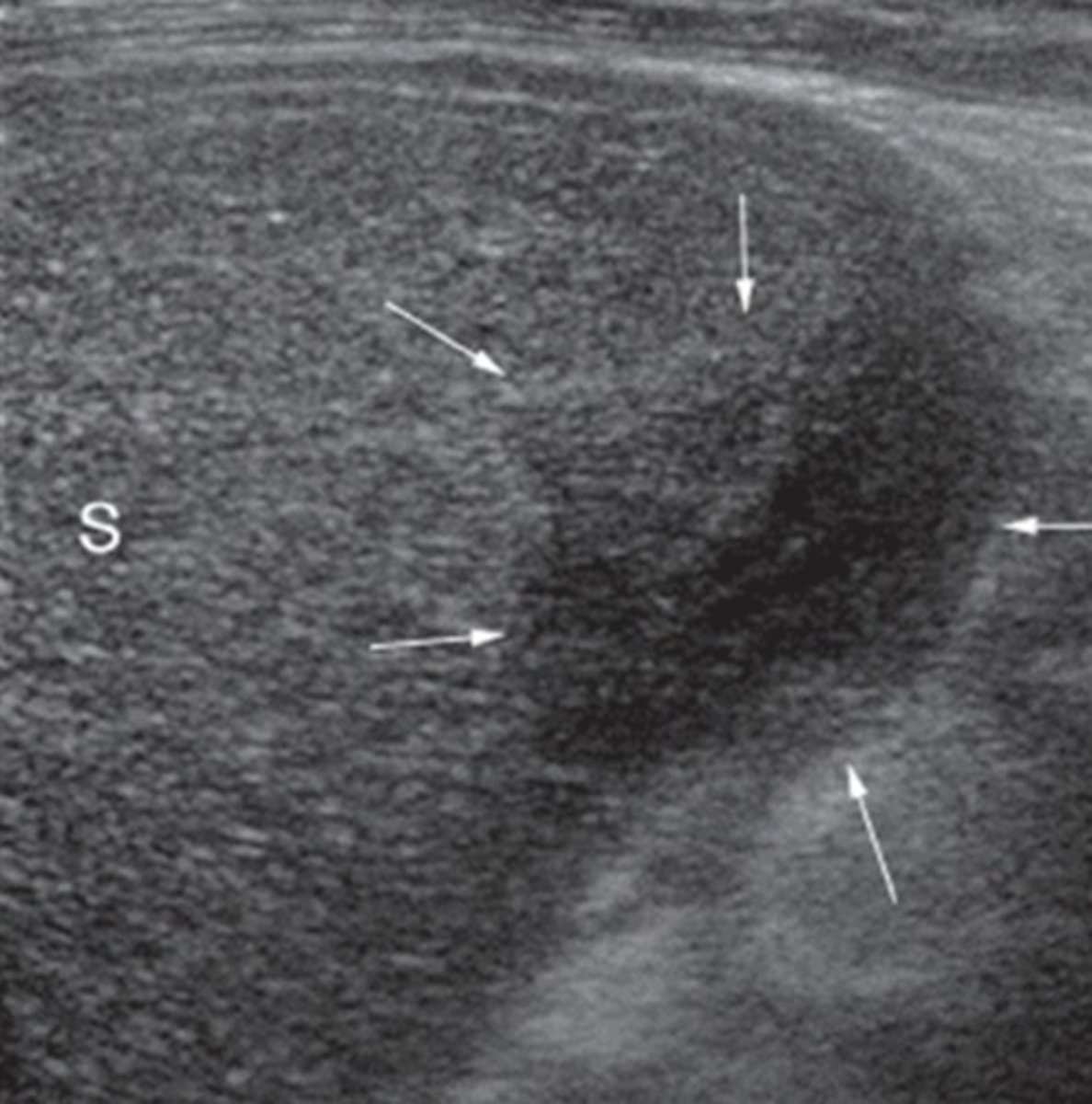<p>Blood trapped between splenic capsule and parenchyma</p>