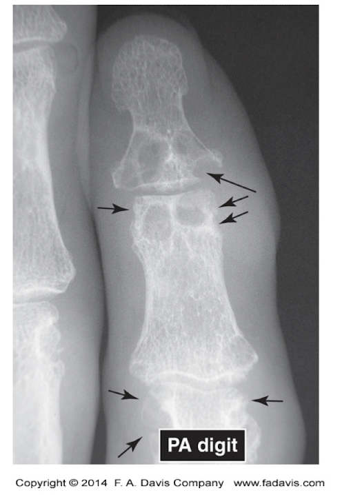 <ul><li><p>Gout</p><ul><li><p>Increased Radiolucency </p><ul><li><p>Subchondral bone erosions </p></li><li><p>Minimal Sclerosis </p></li></ul></li></ul></li></ul><p></p>