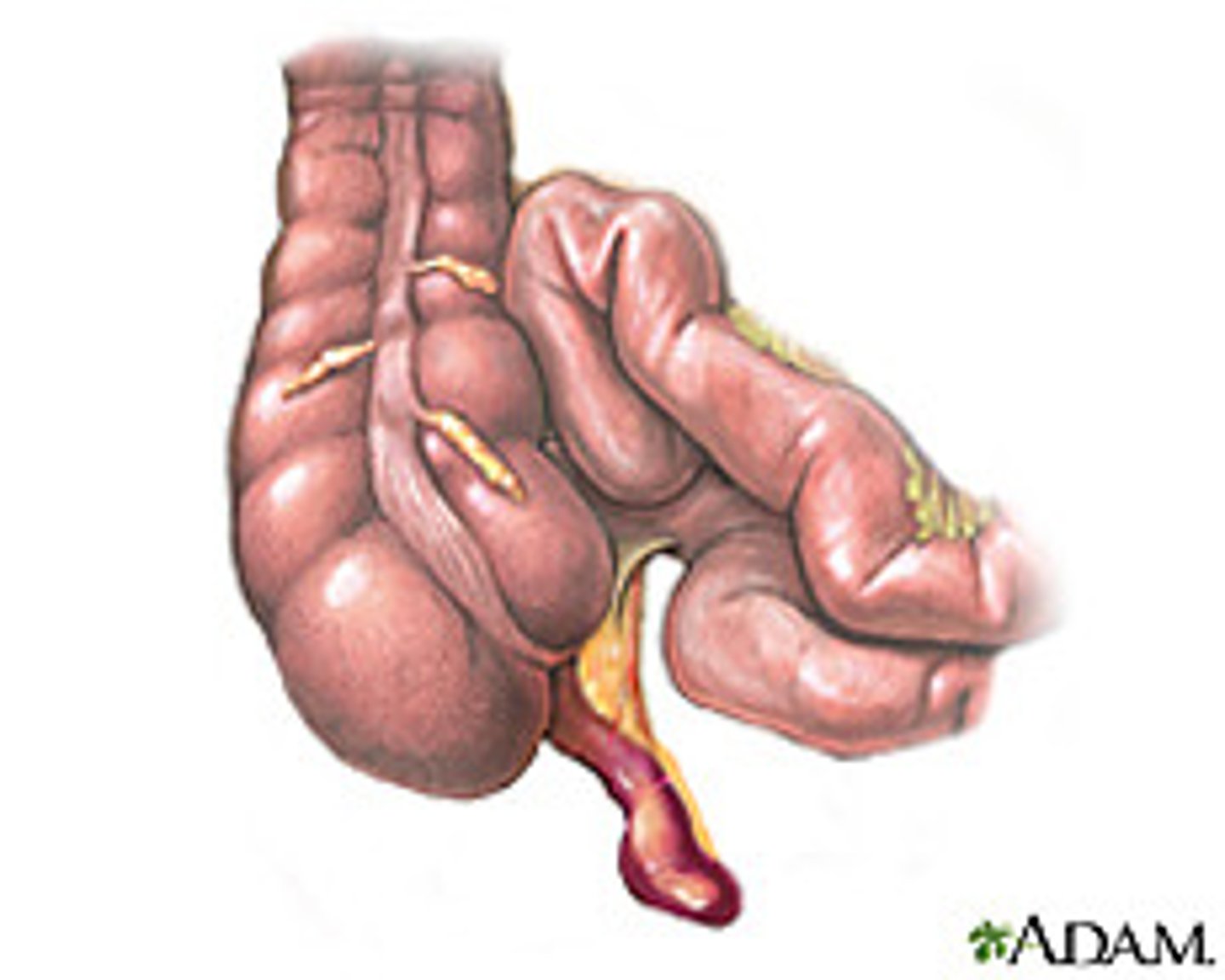 <p>obstruction of appendix by a fecalith, inflammation, foreign body, or neoplasm -&gt; leads to increased intraluminal pressure, venous congestion, infection and thrombosis of intramural vesses</p><p>S/Sx: vague pain, pain shift to RLQ, N/V, low fever</p>