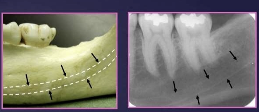 <p>arises at the mandibular foramen on the lingual side of the ramus and passes forwards and downwards, moving from the lingual side in the third molar region to the buccal side in the premolar region</p><p>it contains the inf alveolar nerves and vessels</p>