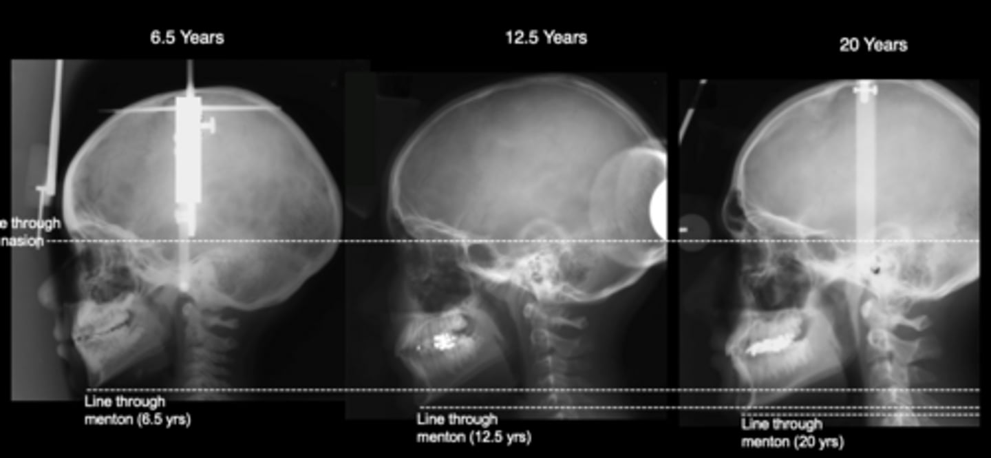 <p>The facial skeleton continues to grow long after the</p>