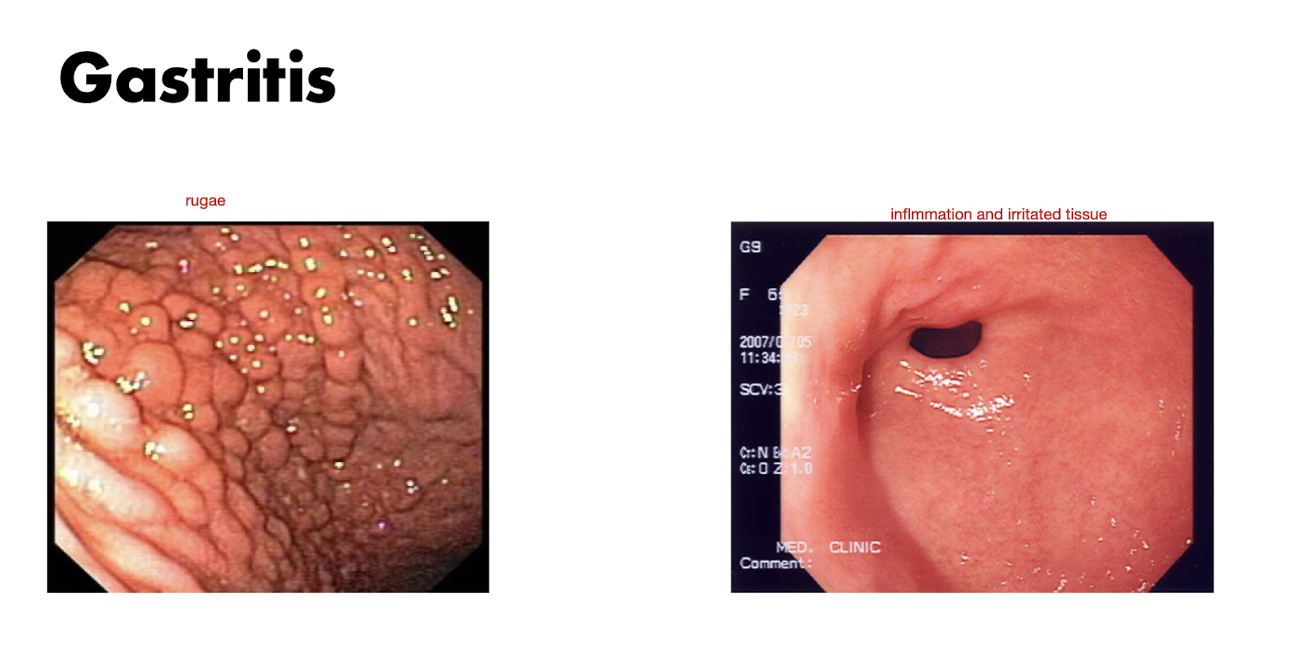 <p>Stomach Pain: Gastritis </p><ul><li><p>Gastritis is a condition that affects what?</p></li><li><p>Acute Gastritis = (2)</p></li><li><p>Chronic Gastritis = (3)</p></li></ul><p></p>