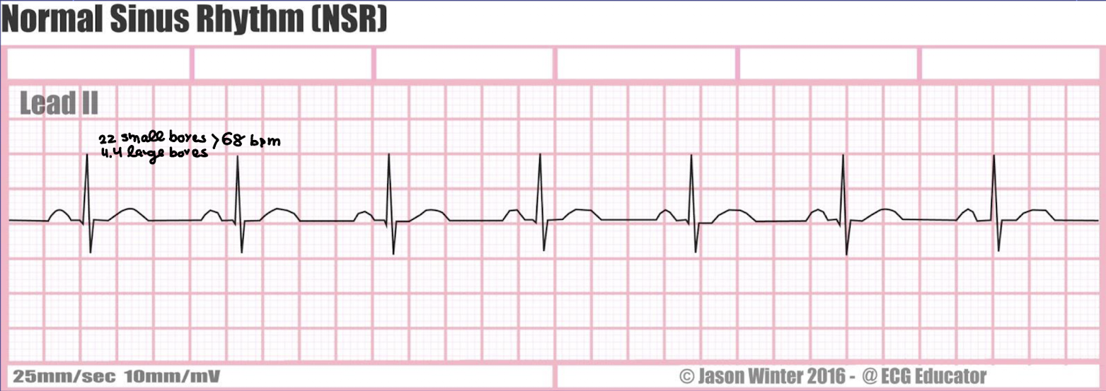 <ol><li><p>rate: 60-100 beats/min</p></li><li><p>rhythm: regular</p></li><li><p>P waves: present, consistent configurations, one P wave before each QRS complex with the spacing between each other P waves being regular</p></li><li><p>PR interval: 0.12-0.20 second and constant</p></li><li><p>QRS interval: 0.04-0.10 second and constant</p></li></ol><p></p>