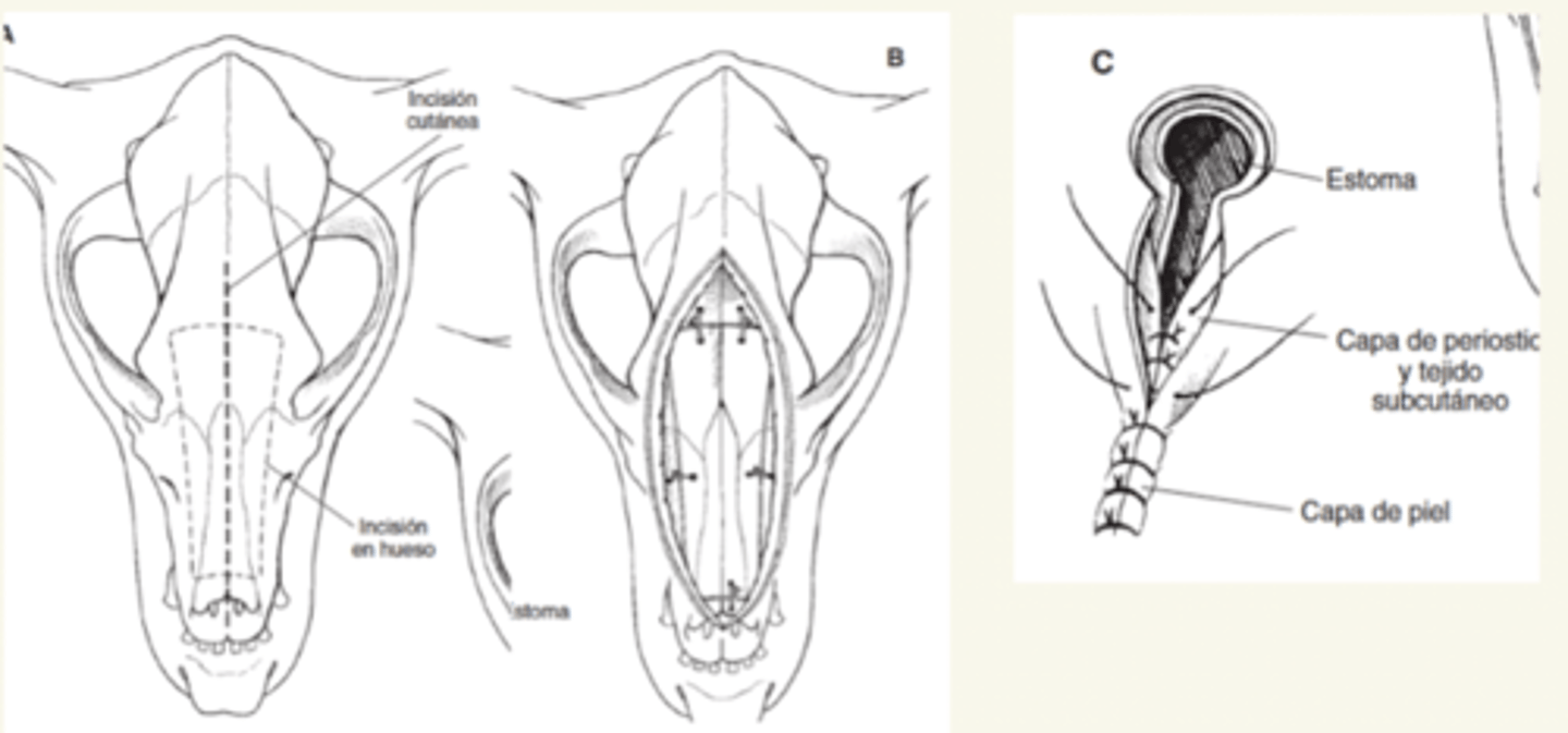 <p>1. generamos una fractura, cortando el hueso nasal y lo quitamos</p><p>2. curetaje: limpiar la zona con una cureta/ cucharilla</p><p>3. poner gaza en la nariz</p><p>4. recolocar el hueso nasal</p><p>5. sutura: periostio- SC- piel</p>