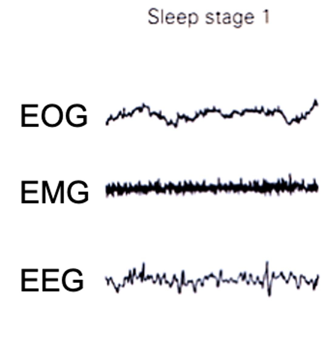 <p>Describe what is happening in EMG</p>